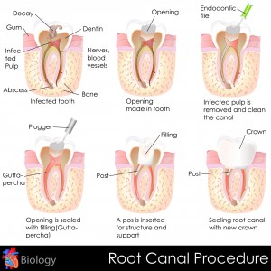 root canals preserve teeth