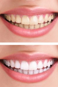 Best teeth whitening in Billings